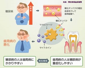 歯周病は糖尿病の合併症です