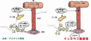 慶応大学はインスリン抵抗性が糖尿病の原因だと発表