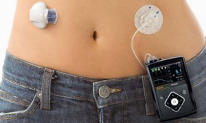 1型糖尿病治療のインスリン自動投与デバイス