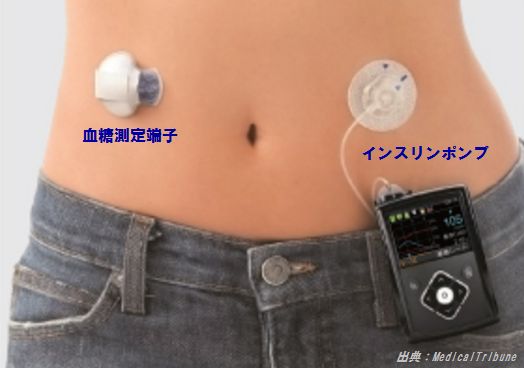 昨年開始されたSAP療法は究極のインスリン療法ののか