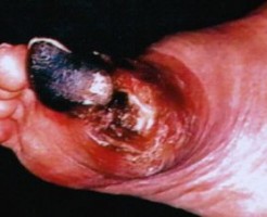 糖尿病壊疽で増えている足切断の原因は足の潰瘍