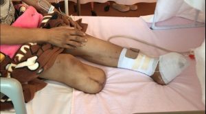 糖尿病合併症の進行